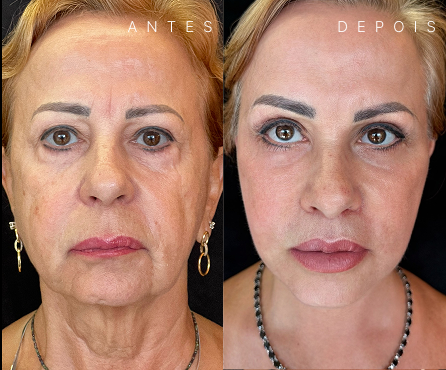 Liplifting 3